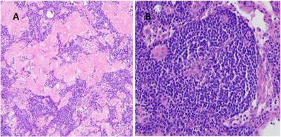 Diagnostic challenges in patients with Castleman disease, a single center experience from Hungary